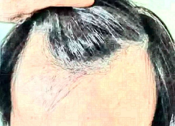 大連發(fā)際線種植費用要多少?大連發(fā)際線種植醫(yī)院推薦