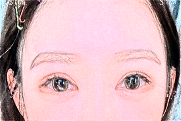 2024割雙眼皮價目表_深圳嘉美怎么樣