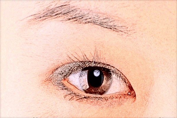 2024開(kāi)眼角價(jià)目表公布_開(kāi)眼角有疤痕增生怎么辦