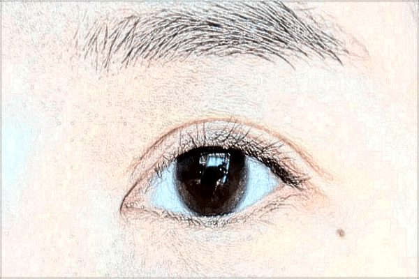 割雙眼皮要多長時間完成?割雙眼皮要拆線嗎?