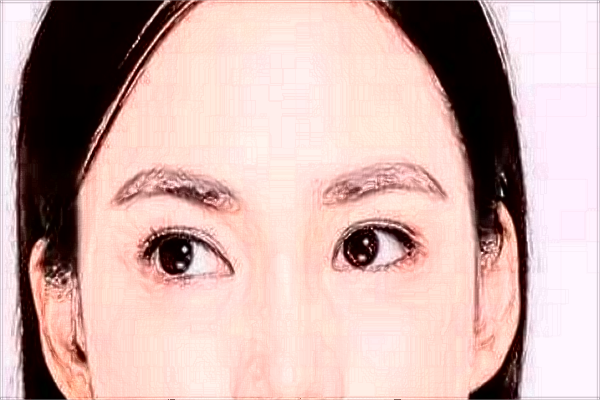 割雙眼皮需要多少錢一次?割雙眼皮需要恢復(fù)多長時(shí)間?