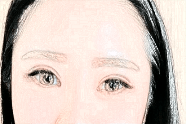 割雙眼皮需要住院嗎?割雙眼皮需要打麻藥嗎?