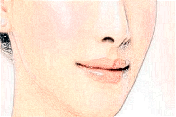 義烏玻尿酸豐唇醫(yī)院推薦_玻尿酸豐唇幾天可以恢復(fù)自然