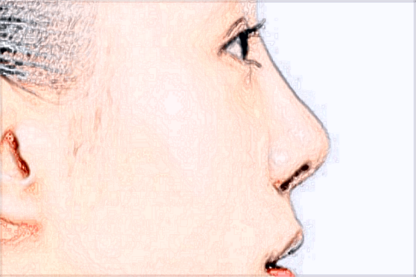 河南中醫(yī)大一附院隆鼻價格表_趙絳波醫(yī)生好不好