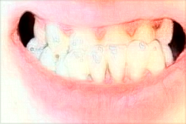 2024單顆牙種植收費(fèi)價(jià)格表(價(jià)目表)一覽