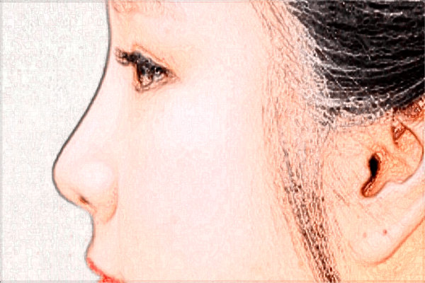 2024四川省中醫(yī)院激光祛痘收費(fèi)價(jià)格怎么樣