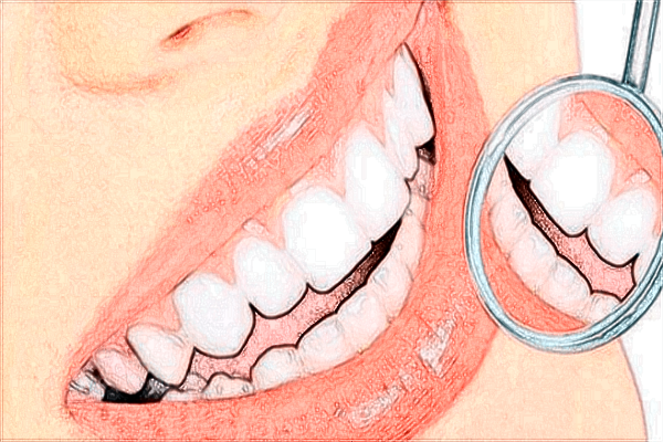 2024沈陽(yáng)二院補(bǔ)牙價(jià)目表_補(bǔ)牙后需要做牙套嗎