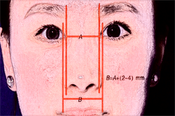 長沙梵童醫(yī)院熱瑪吉價格表?熱瑪吉功效與副作用
