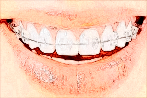 2024-2024齙牙矯正價目表公布_齙牙矯正的佳年齡是什么時候