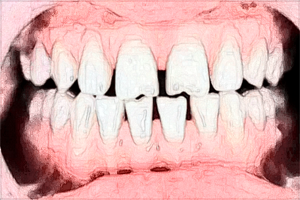 2024牙齒缺損修復(fù)價目表_牙齒缺損修復(fù)方法有哪些