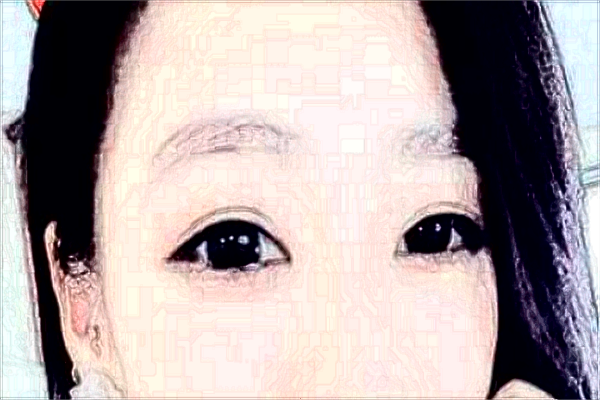 2024北京麗都割眼袋怎么樣_北京麗都割眼袋案例