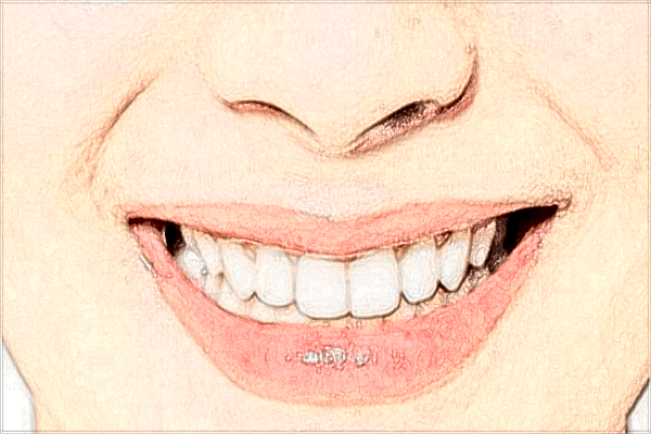 北京大學(xué)第三醫(yī)院牙齒正畸價格?牙齒矯正有幾種方式