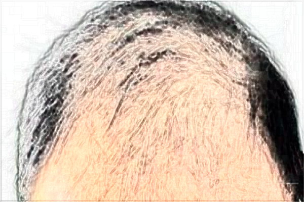 上海植發(fā)醫(yī)院哪家技術好_植發(fā)多少錢