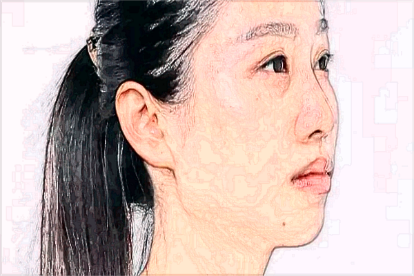 玻尿酸豐面頰有危害嗎?玻尿酸豐面頰多久吸收?