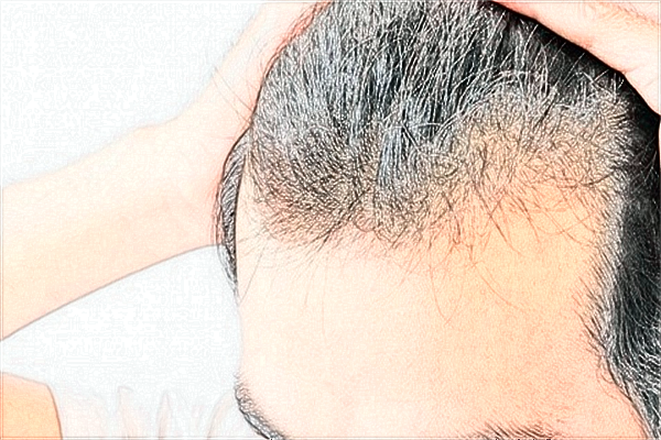 北京煤醫(yī)植發(fā)怎么樣?2024北京煤醫(yī)植發(fā)價(jià)格表