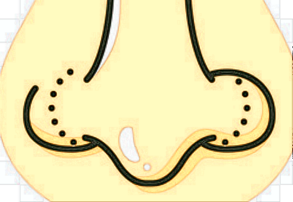 膨體隆鼻有什么后遺癥?膨體隆鼻有風(fēng)險(xiǎn)嗎?