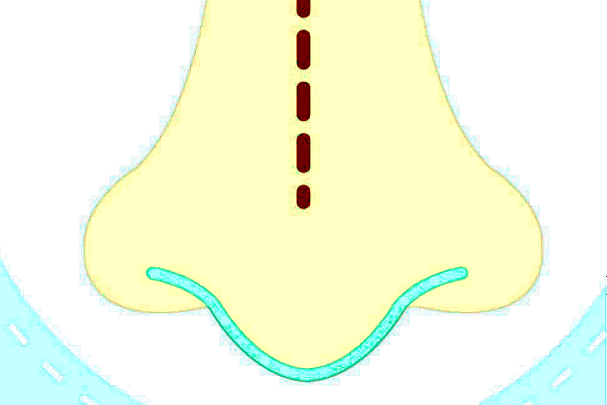 膨體隆鼻要多長(zhǎng)時(shí)間?膨體隆鼻要住院?jiǎn)?