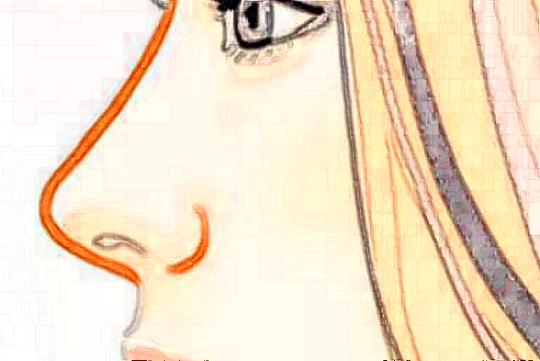 膨體隆鼻需要拆線嗎?膨體隆鼻需要幾天恢復(fù)?