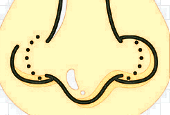 膨體隆鼻需要墊鼻尖嗎?膨體隆鼻需要恢復多久可以自然?