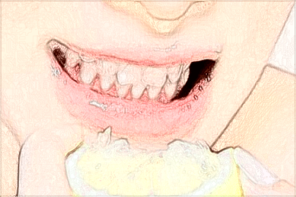 2024四川省人民醫(yī)院口腔科補(bǔ)牙醫(yī)生推薦【補(bǔ)牙案例】