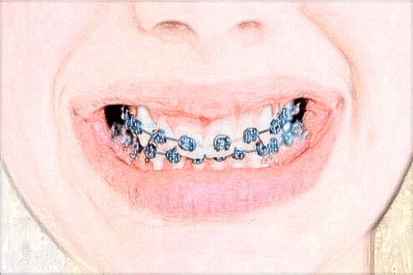 2024四川省人民醫(yī)院口腔科補牙多少錢_價格表+案例