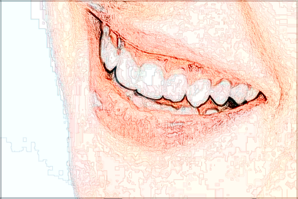 四川省人民醫(yī)院拔智齒多少錢【拔智齒案例】