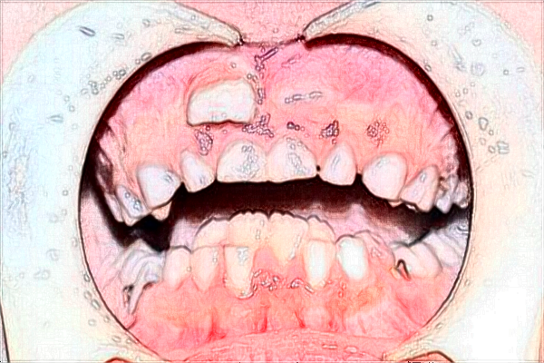 2024福建醫(yī)科大學(xué)附屬協(xié)和醫(yī)院牙齒矯正多少錢(qián)