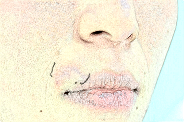 成都格萊麗祛痘好不好?2024激光祛痘價(jià)格