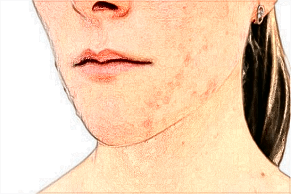 自體脂肪豐面頰多少錢(qián)?自體脂肪豐面頰多久可以做第二次?