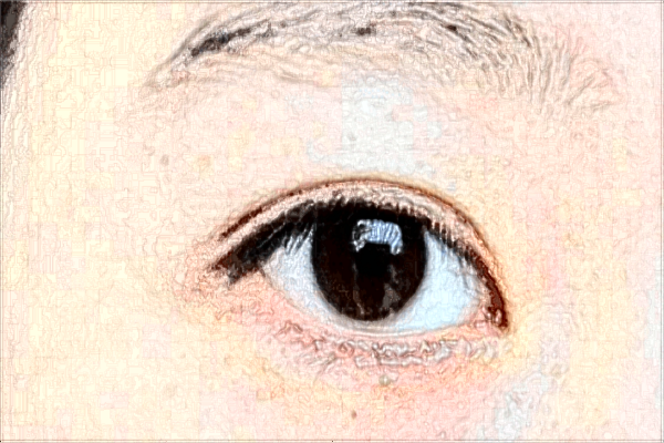 2024成都格萊麗做雙眼皮價(jià)格?醫(yī)生雙眼皮案例