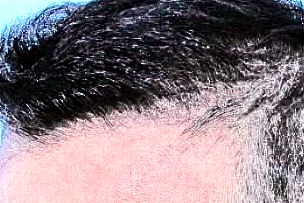 上海曙光醫(yī)院植發(fā)怎么樣_做的好不好