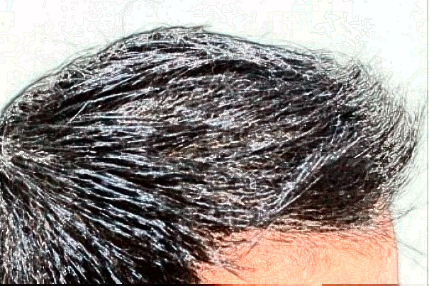 上海曙光醫(yī)院植發(fā)怎么樣_做的好不好