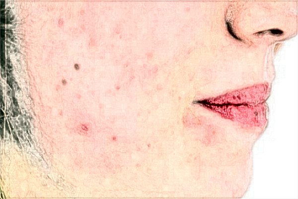 漳州175醫(yī)院祛斑好不好?2024漳州175醫(yī)院激光祛斑價格