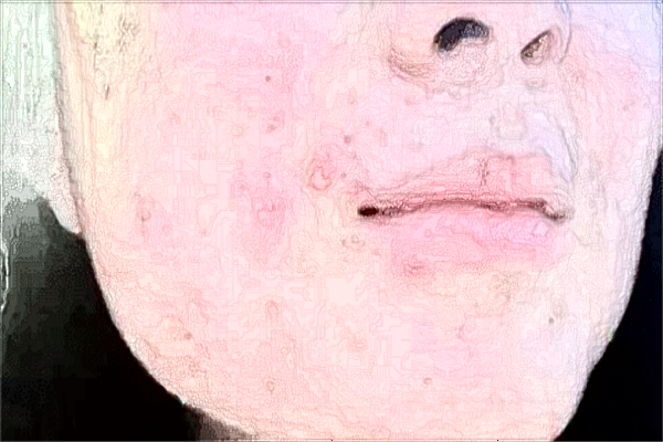 漳州175醫(yī)院祛疤怎么樣?2024祛疤手術(shù)大概需要多少錢