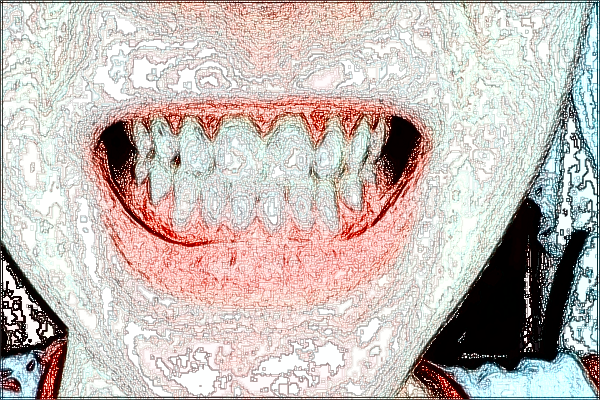 北大口腔醫(yī)院隱形口腔正畸價格表_案例