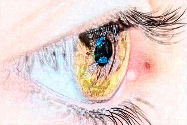 河科大二附院割雙眼皮怎么樣?割雙眼皮新整形價格2024