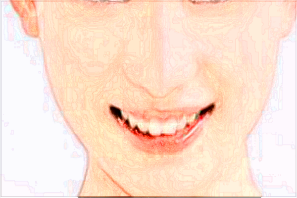 成都華西醫(yī)院去眼袋怎么樣【去眼袋案例】