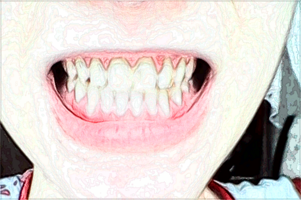 北大口腔醫(yī)院植牙一般需要去幾次_醫(yī)院技術(shù)怎么樣