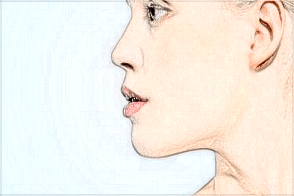 2024西安二院拉皮收費(fèi)價(jià)格?拉皮副作用有哪些