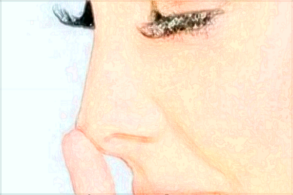 2024廣州華美鼻子哪個(gè)醫(yī)生做的好【做鼻子案例】