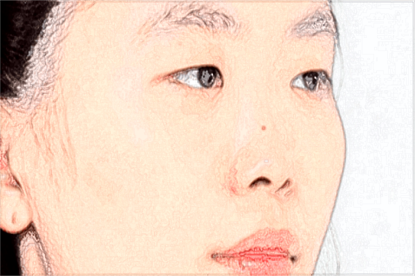 南昌大學第一附屬醫(yī)院去除胎記貴嗎?2024去除胎記的費用