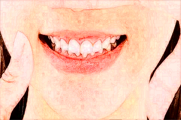 2024寧波市第一醫(yī)院牙科種植怎么樣【牙齒種植案例】