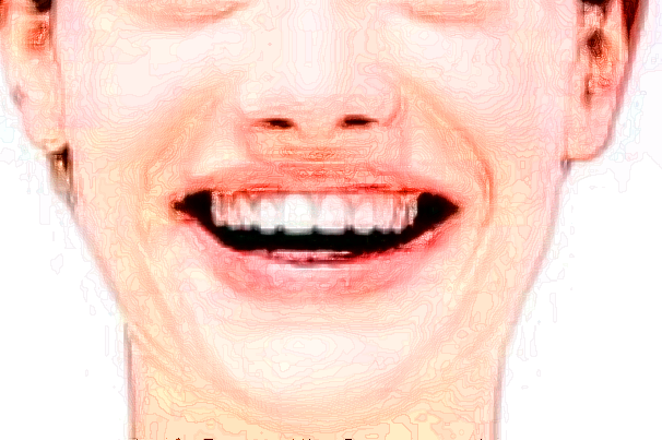 2024寧波市第一醫(yī)院牙齒貼面那個(gè)醫(yī)生做的好_做的怎么樣