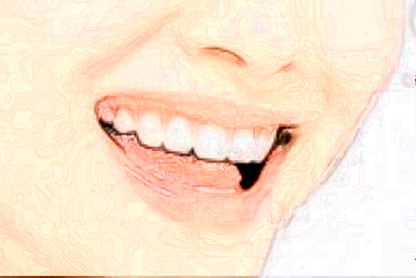 寧波市第一醫(yī)院牙齒美容做的好嗎【牙齒美容案例】