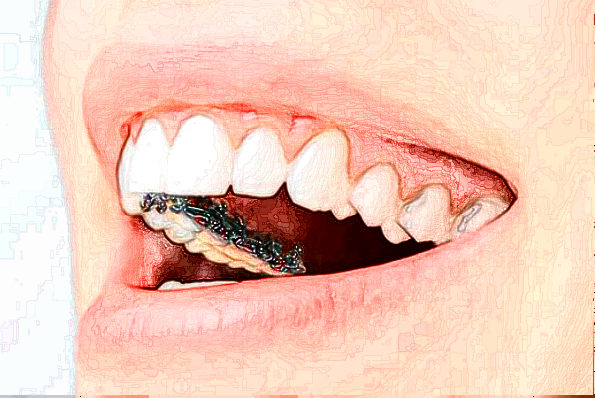 浙江省中醫(yī)院補牙做的好嗎_案例+價格