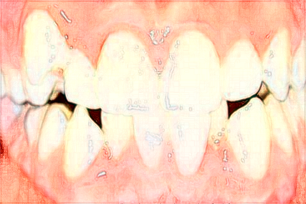 吉安市中心人民醫(yī)院口腔科種植牙口碑_收費價格