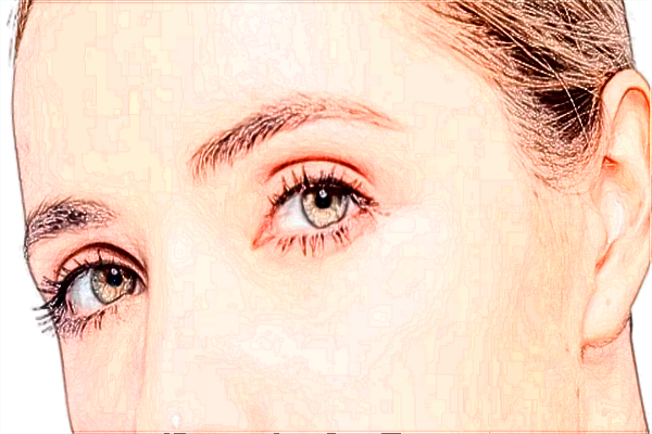 2024保定市第一中心醫(yī)院去眼袋多少錢_案例+價(jià)格分享