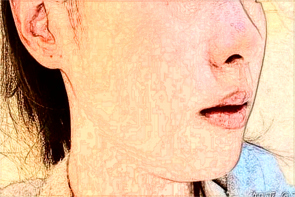 大連醫(yī)科大學(xué)附屬第一醫(yī)院激光去紅血絲做的好嗎_案例價(jià)格分享