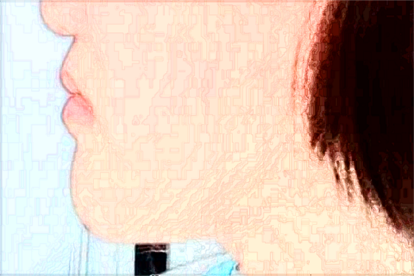 大連醫(yī)科大學附屬第一醫(yī)院熱瑪吉怎么樣_醫(yī)生技術好不好