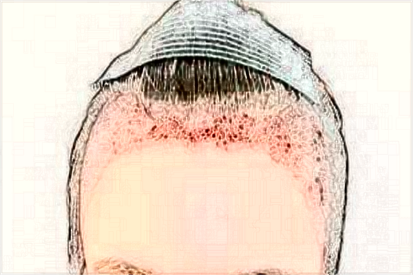 2024常州市第一人民醫(yī)院植發(fā)價(jià)目表(價(jià)格表)怎么樣